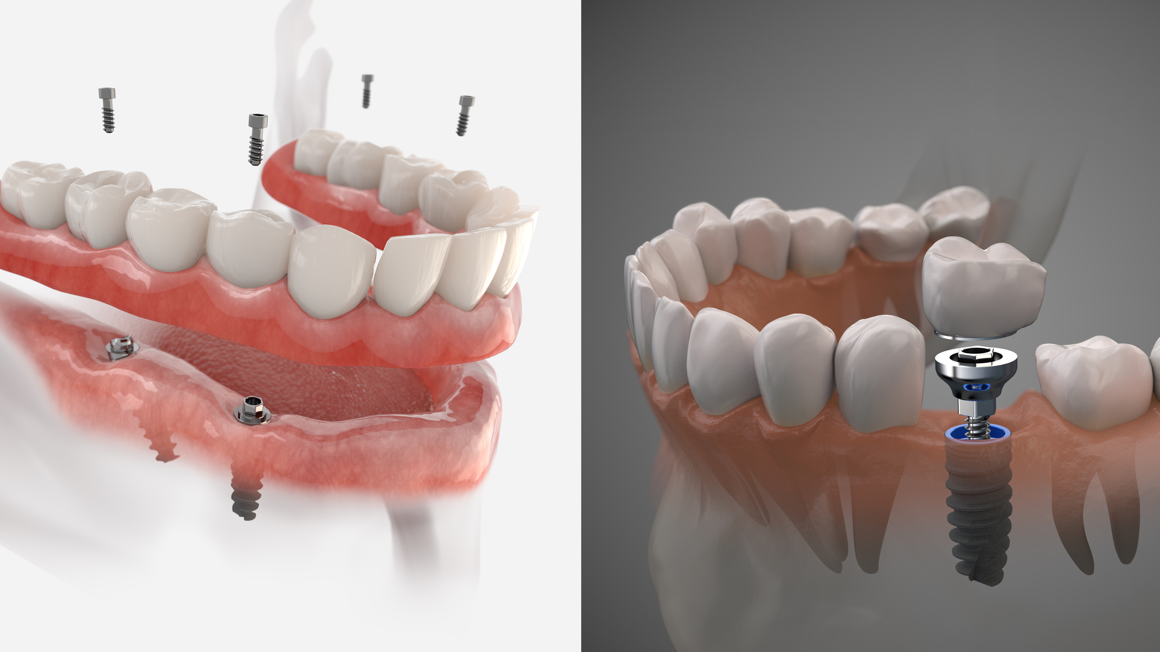 Explicação sobre o implante dentário